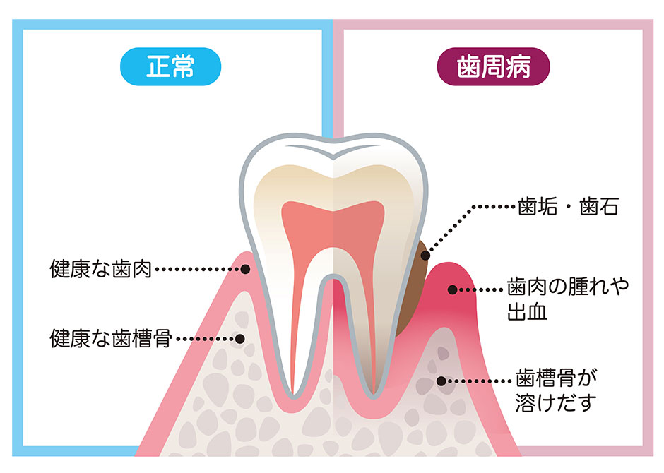 歯周病