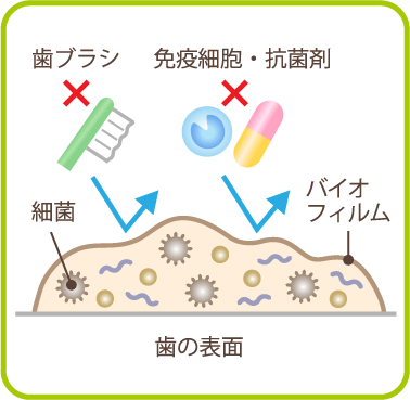 歯肉の健康状態を保つためのクリーニング